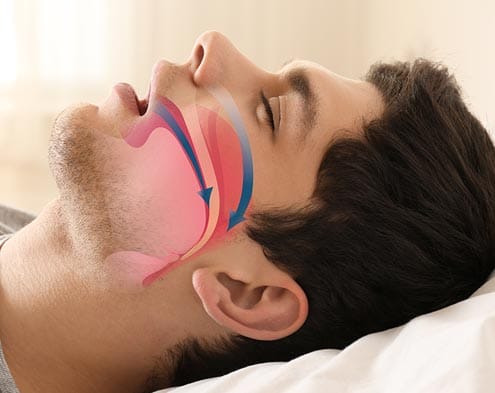 Sleep Apnea Treatment in Oak Park, IL 