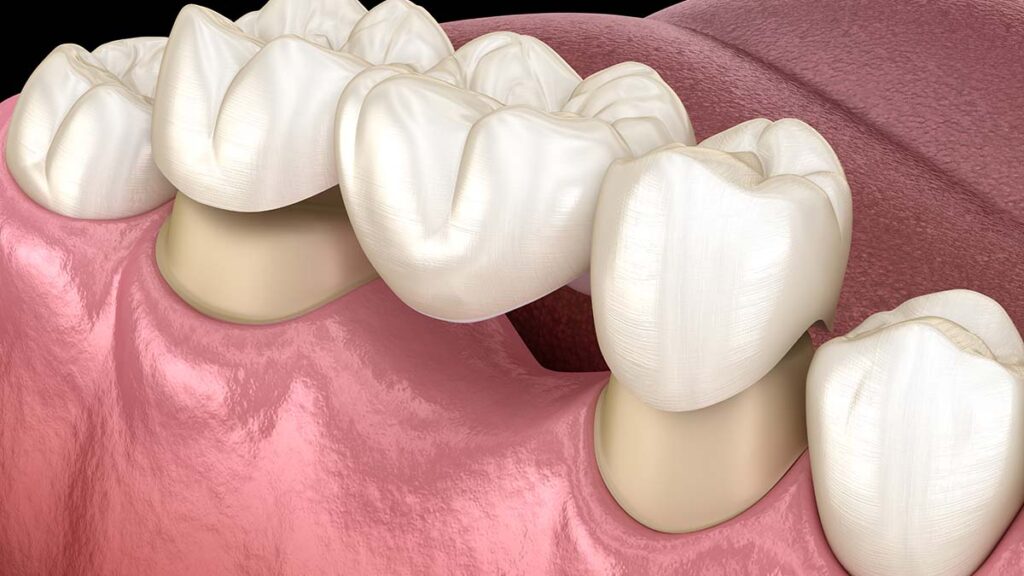 Close-up 3D illustration of a dental bridge placed over prepared teeth.
