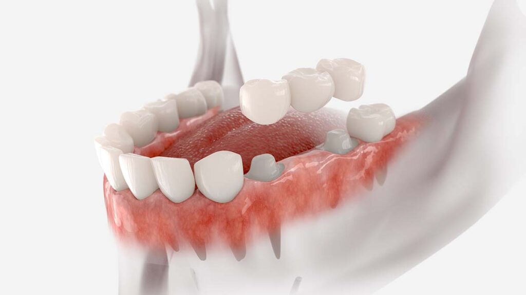 3D illustration of a dental bridge being placed to replace a missing tooth.
