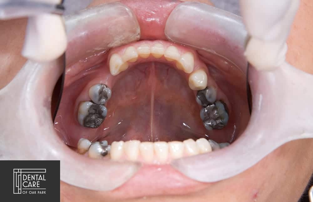 worn out teeth