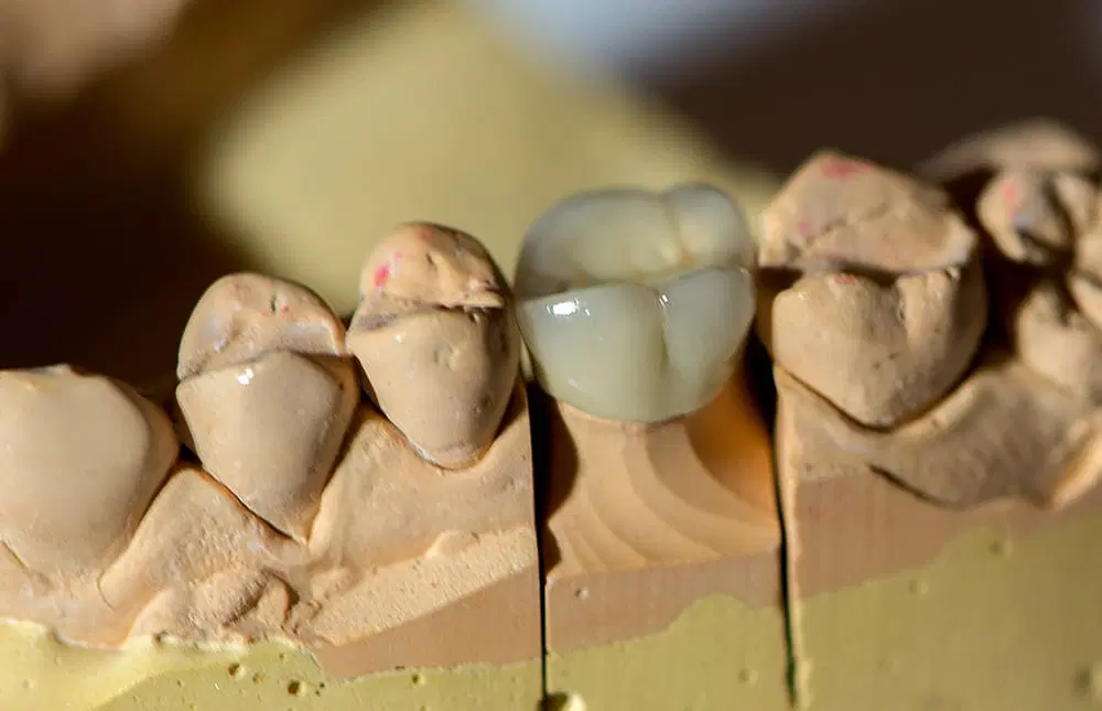 Dental-prosthesis