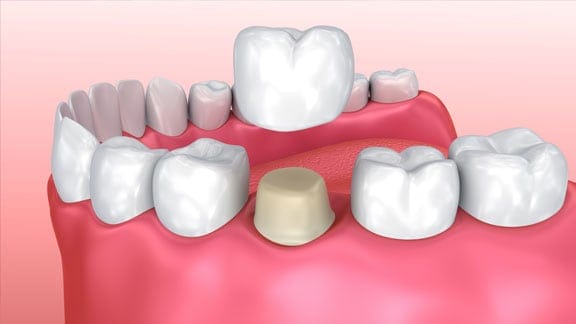 Illustration of a dental crown restoring a damaged tooth