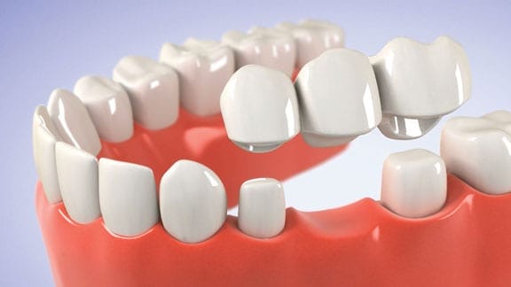 Illustration of a dental bridge replacing a missing tooth