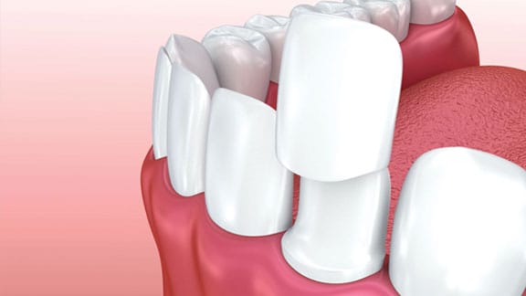 Illustration of porcelain veneers improving the appearance of front teeth