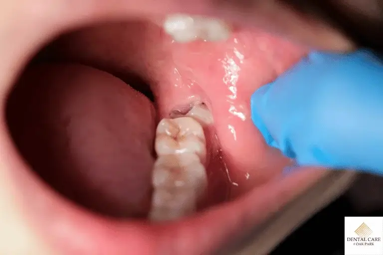 close-up-of-wisdom-tooth-extraction-site