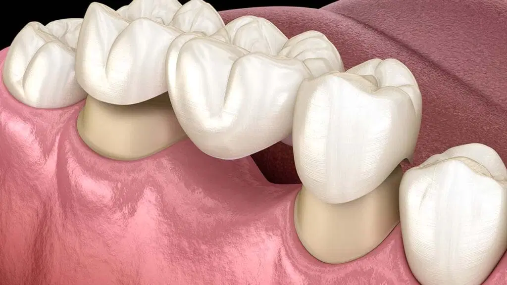 dental-bridge