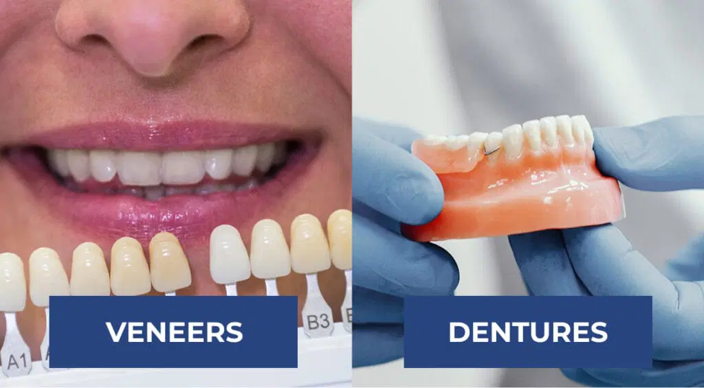 veneers-vs-dentures