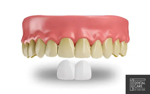 veneers