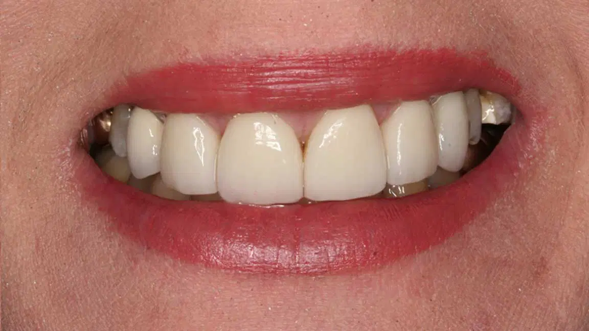 after veneers