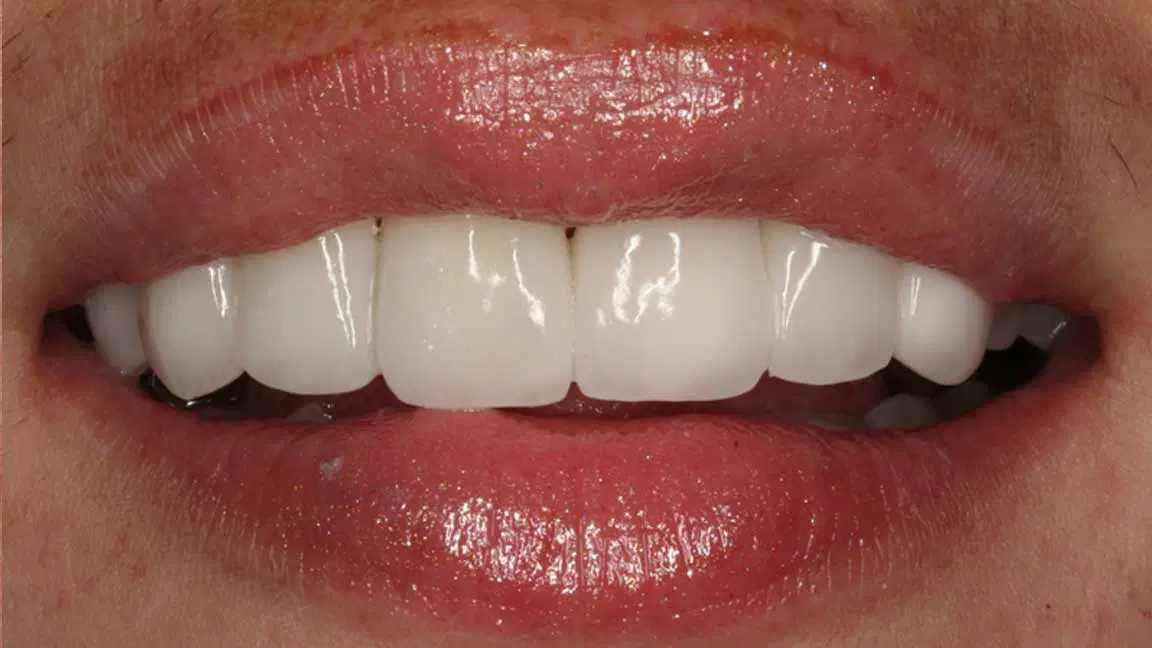 after veneers