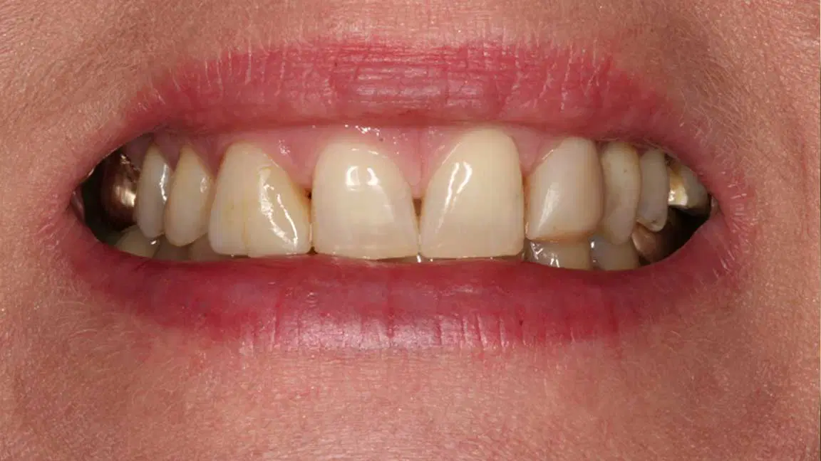 before veneers