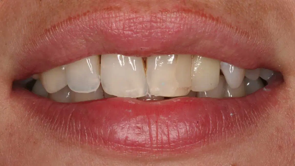 before veneers