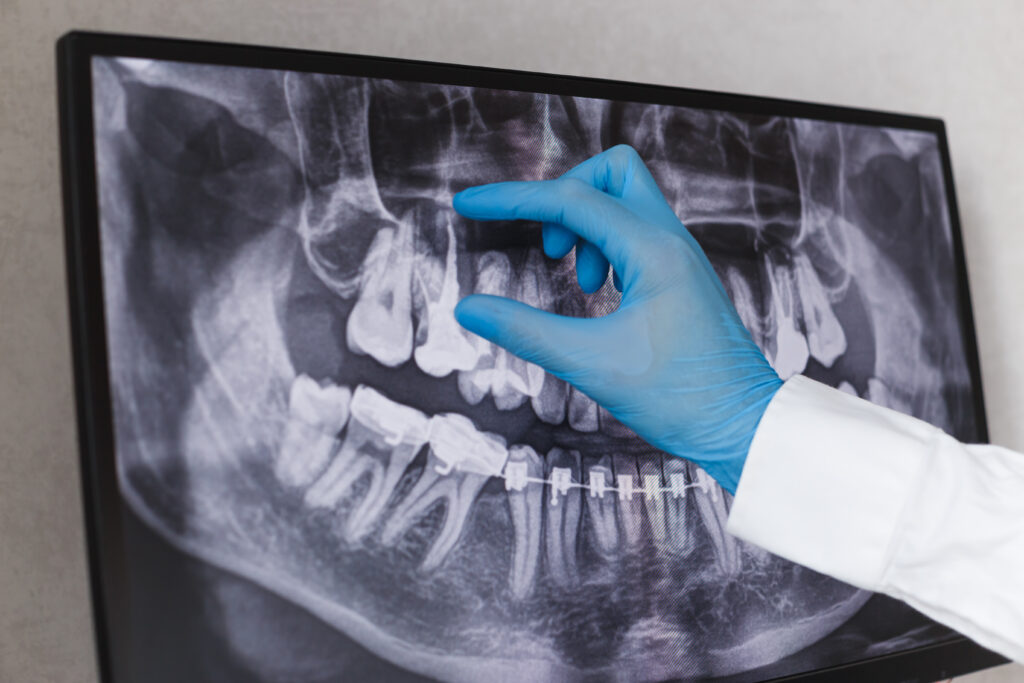Dentist reviewing a panoramic dental X-ray to diagnose oral health conditions